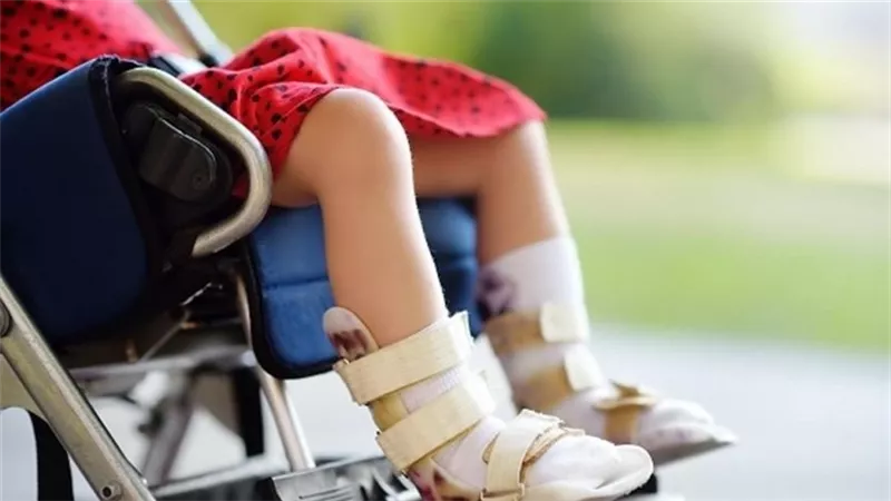 الصحة تكشف أسباب وأعراض الإصابة بمرض شلل الأطفال
