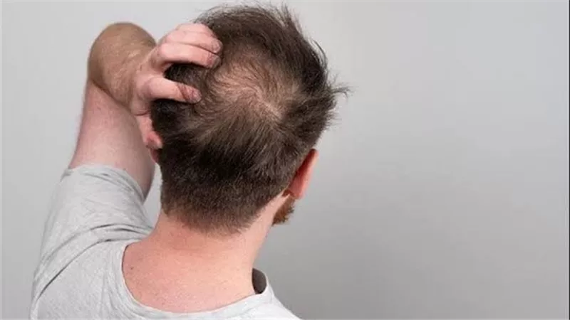 أنقذ شعرك قبل فوات الأوان.. عادة تضر الشعر وتؤدي إلى الصلع