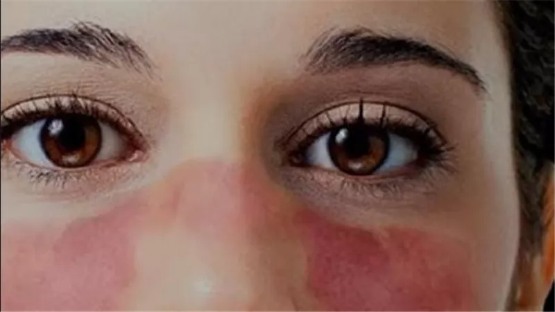 مرض الذئبة الحمراء أسبابه وأعراضه وكيفية التعايش معه