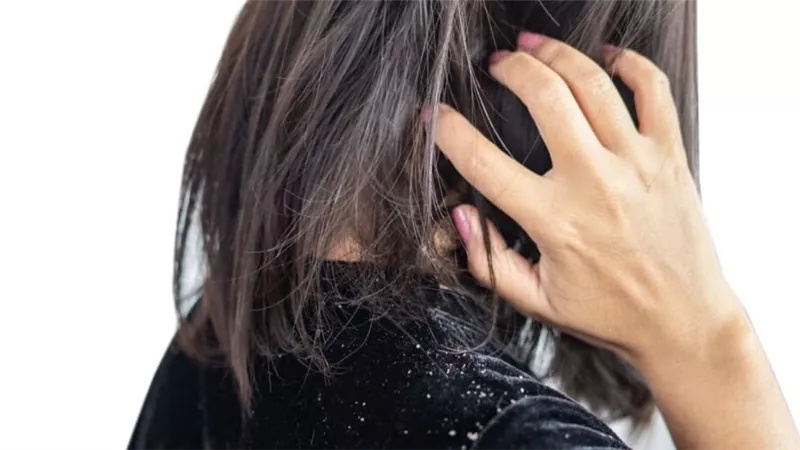 6 حلول طبيعية للتخلص من قشرة الشعر.. فعالة وغير مكلفة