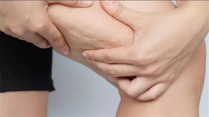 ما هي أسباب ظهور السيلوليت وكيفية علاجه بفعالية؟