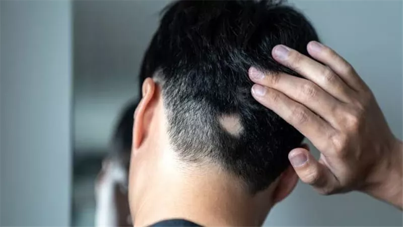 أفضل الطرق لعلاج الثعلبة بالزيوت الطبيعية والأدوية.. تعرف عليها