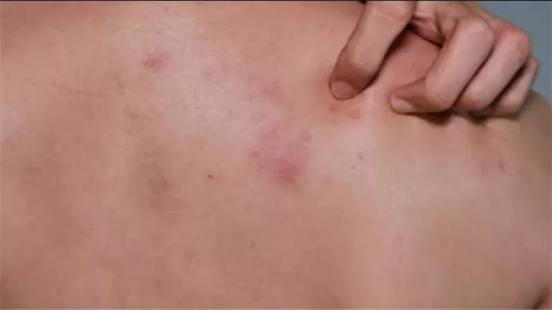 لمن فوق الخمسين.. تعرف على مخاطر الحزام الناري ومضاعفاته لدى كبار السن