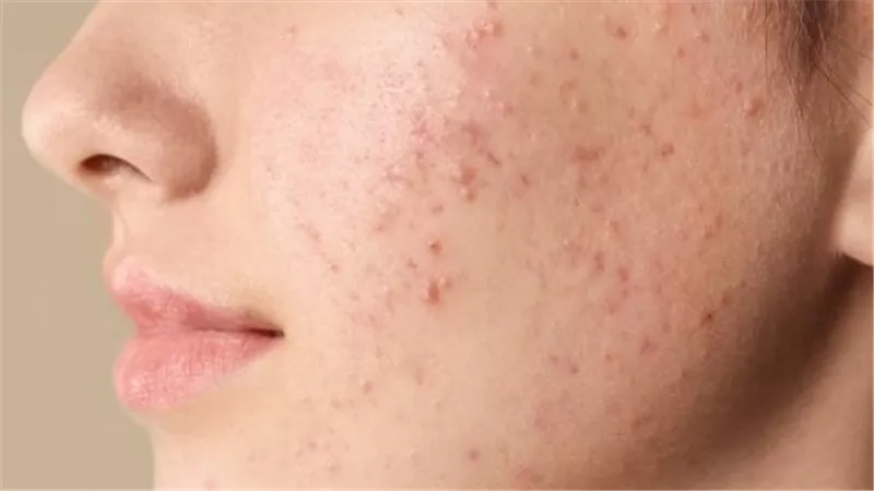 بمكونات آمنة وطبيعية.. تخلصي من حب الشباب في المنزل