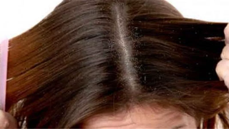 ودعي التساقط للأبد.. 7 حلول مجربة لفروة دهنية صحية
