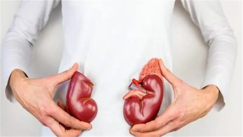 حصوات الكلى تبدأ من هنا.. 3 عادات يجب التخلص منها فورًا