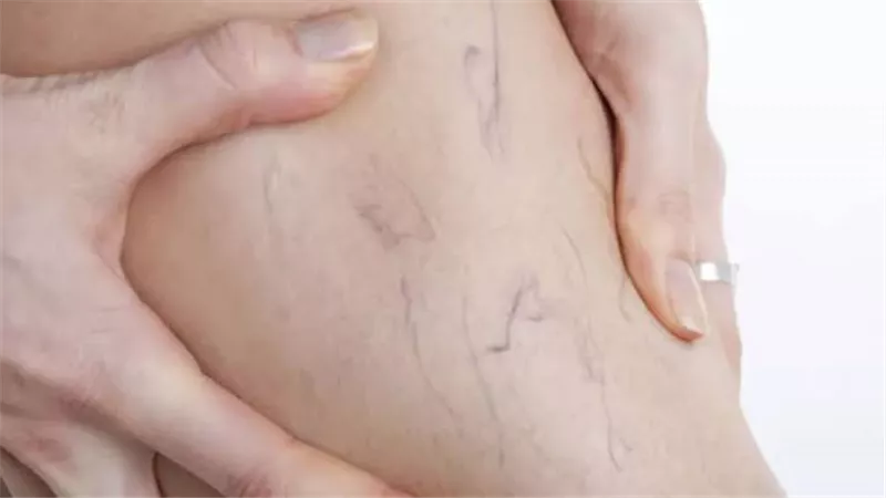 أسباب ظهور الدوالي وطرق فعالة للتخلص منها نهائيًا بدون جراحة 