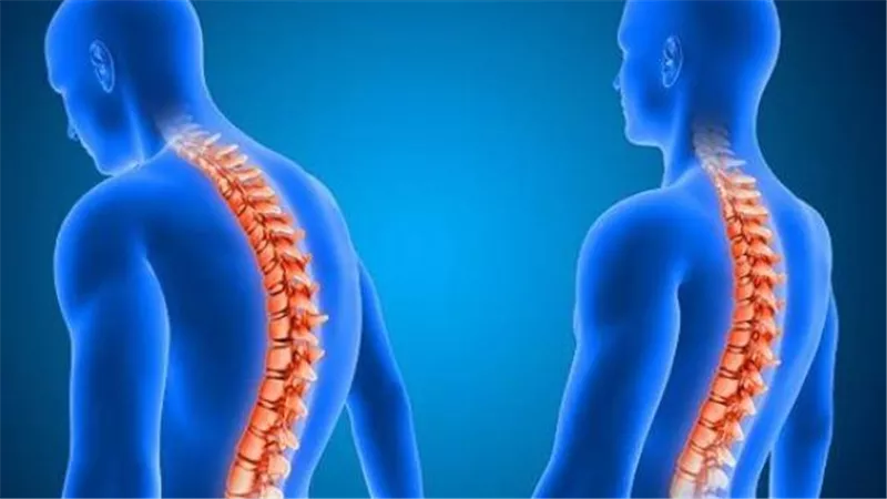 «تحدب الظهر».. الأسباب الخفية والمضاعفات الخطيرة وطرق العلاج الفعالة