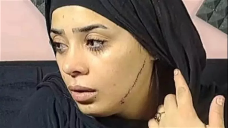التفاصيل الكاملة حول واقعة تشوية وجه عروسة بـ41 غرزة في مصر القديمة