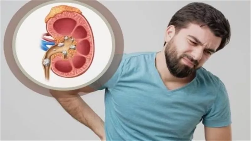 ألم الظهر يكشف أعراض «حصوات الكلى» وطرق الوقاية