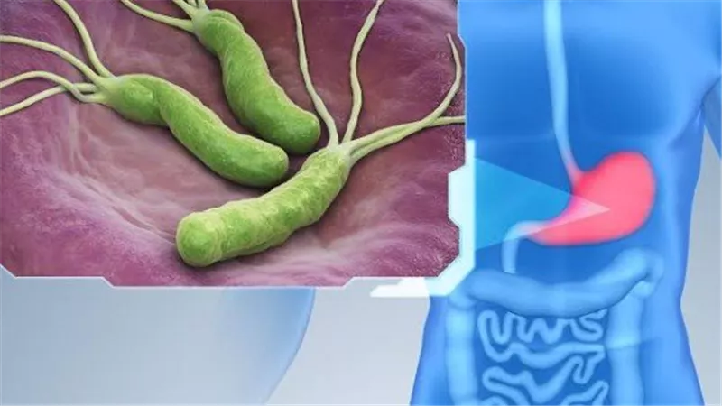 أغذية ومشروبات تجنبها خلال فترة علاج «جرثومة المعدة»