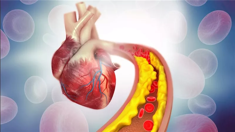 إنذار صامت: ارتفاع الكوليسترول يهدد القلب.. أبرز علامات الخطر