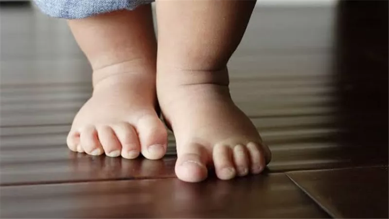 أعراض مرض الكساح وعلاقته بنقص فيتامين د الشهير