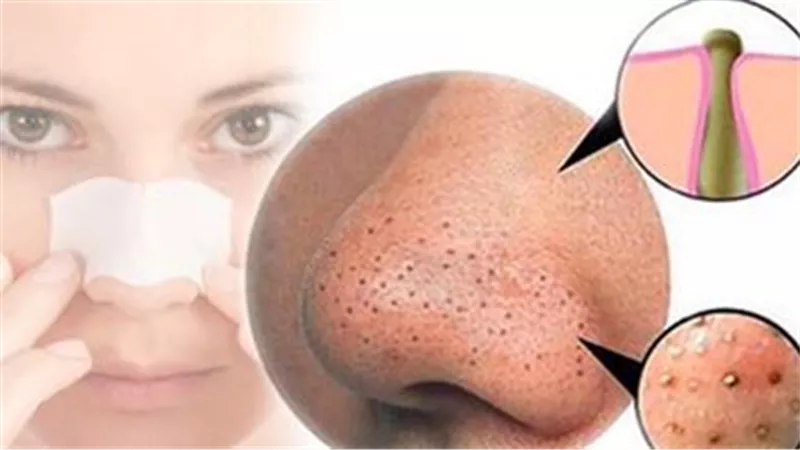 تخلصي من بثور الأنف بخطوات سهلة وفعالة